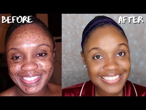 Before and after acne treatment on dark skin – reduced spots and marks