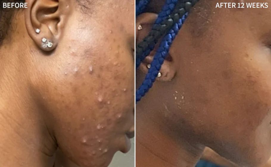Acne improvement and hyperpigmentation fading on Kenyan skin tones